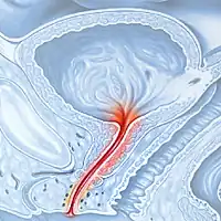 Воспаление мочеиспускательного канала