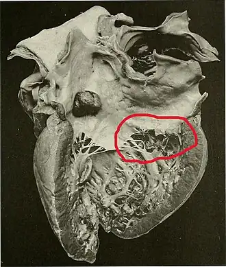 Красным обведена указана область разрыва сердца