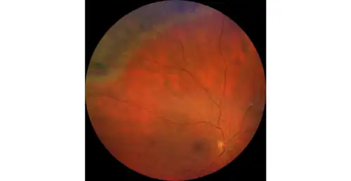 Решётчатая дистрофия после коагуляции