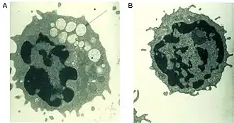 Электронная микроскопия: на микрофотографии слева — вакуолизированный лимфоцит больного маннозидозом, справа — лимфоцит здорового человека.