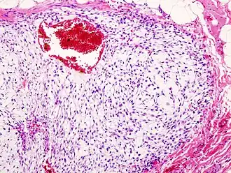 Гистограмма хондромы стенки грудной клетки. Окрашено гематоксилином и эозином.