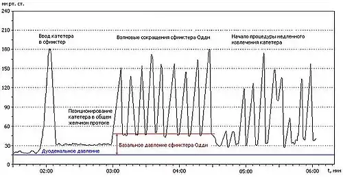 Условный график давления при манометрии сфинктера Одди