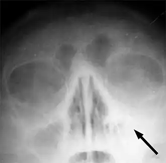 Рентгеновский снимок пазух больного гайморитом (стрелкой обозначено затемнение в области верхнечелюстной пазухи, указывающее на присутствие в ней жидкости)