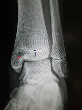 Рентгеновский снимок голеностопного сустава с эпифизеолизом медиальной лодыжки. Красная стрелка - линия перелома, синяя указывает на ростковую зону.