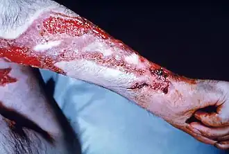 Изъязвления кожи предплечья при споротрихозе